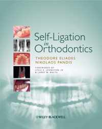 Self-Ligation in Orthodontics