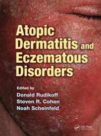 Atopic Dermatitis and Eczematous Disorders