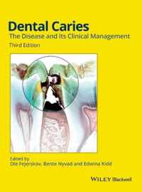 Dental Caries 3rd Edition