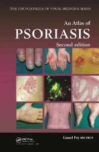 An Atlas of Psoriasis, Second Edition