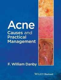 Acne Causes & Practical Management