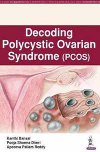 Decoding Polycystic Ovarian Syndrome