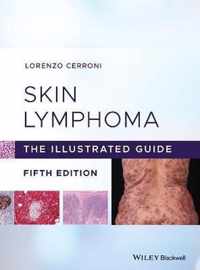 Skin Lymphoma