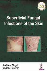 Superficial Fungal Infections of the Skin