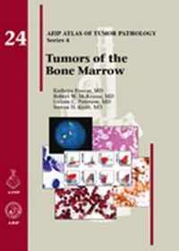 Tumors of the Bone Marrow