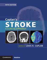 Caplans Stroke