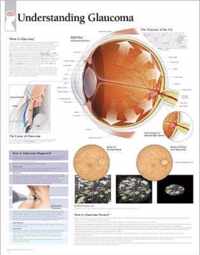 Understanding Glaucoma Laminated Poster
